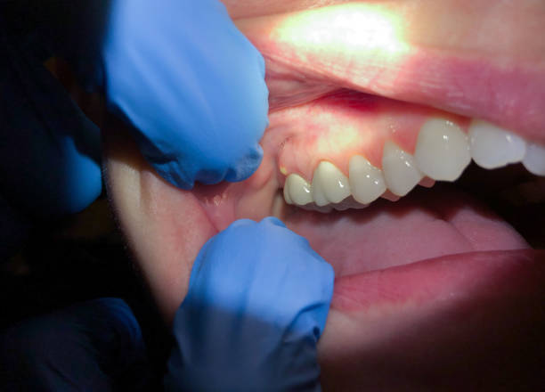 Best Emergency Broken Tooth Repair in Gulfport, MS