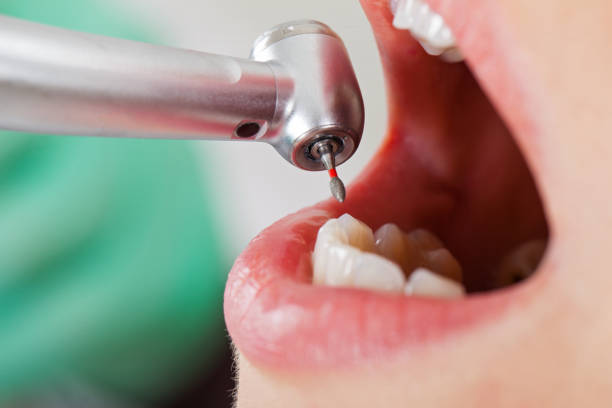 Best Emergency Tooth Extraction in Gulfport, MS